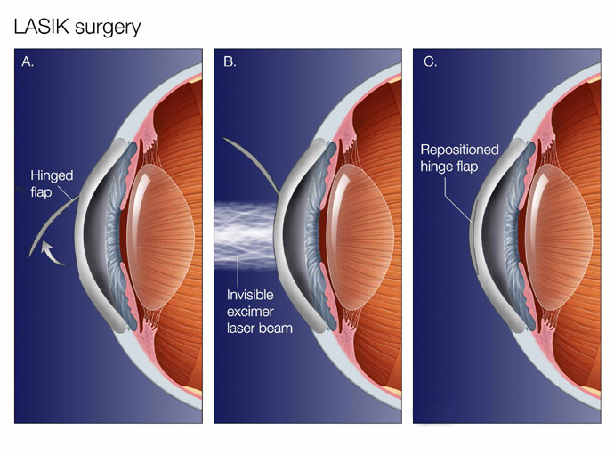 lasik surgery